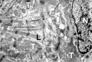 M,47y. | hypertrophic cardiomyopathy - left ventricle ( N - nucleus, T- transversally oriented, L- longitudinally oriented myofibrils )